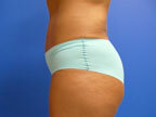 RGV Cosmetic Surgery Vein Care 