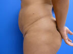 RGV Cosmetic Surgery Vein Care 