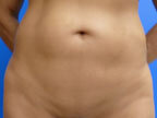RGV Cosmetic Surgery Vein Care 
