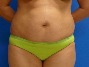 RGV Cosmetic Surgery Vein Care 