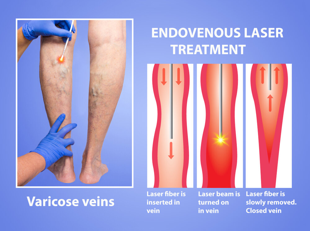 RGV Cosmetic Surgery Vein Care 