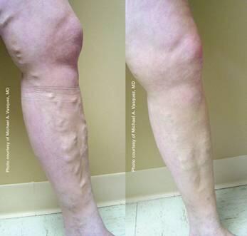 RGV Cosmetic Surgery Vein Care 