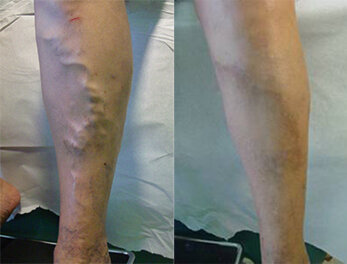 RGV Cosmetic Surgery Vein Care 